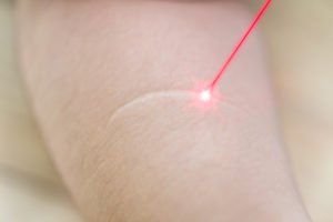 Laser treatment on a persistent scar on the arm