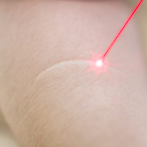 Laser treatment on a persistent scar on the arm
