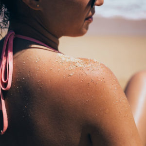 Sunburn