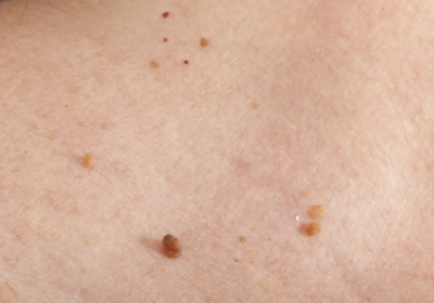 What are Skin Tags Causes amp Removal Schweiger Dermatology