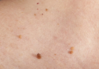 What are Skin Tags? Causes & Removal
