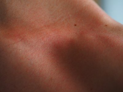 8 Ways Your Body Changes After Just One Sunburn