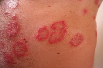 Symptoms of Psoriasis on the body