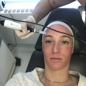 Microneedling NYC | Schweiger Dermatology Group
