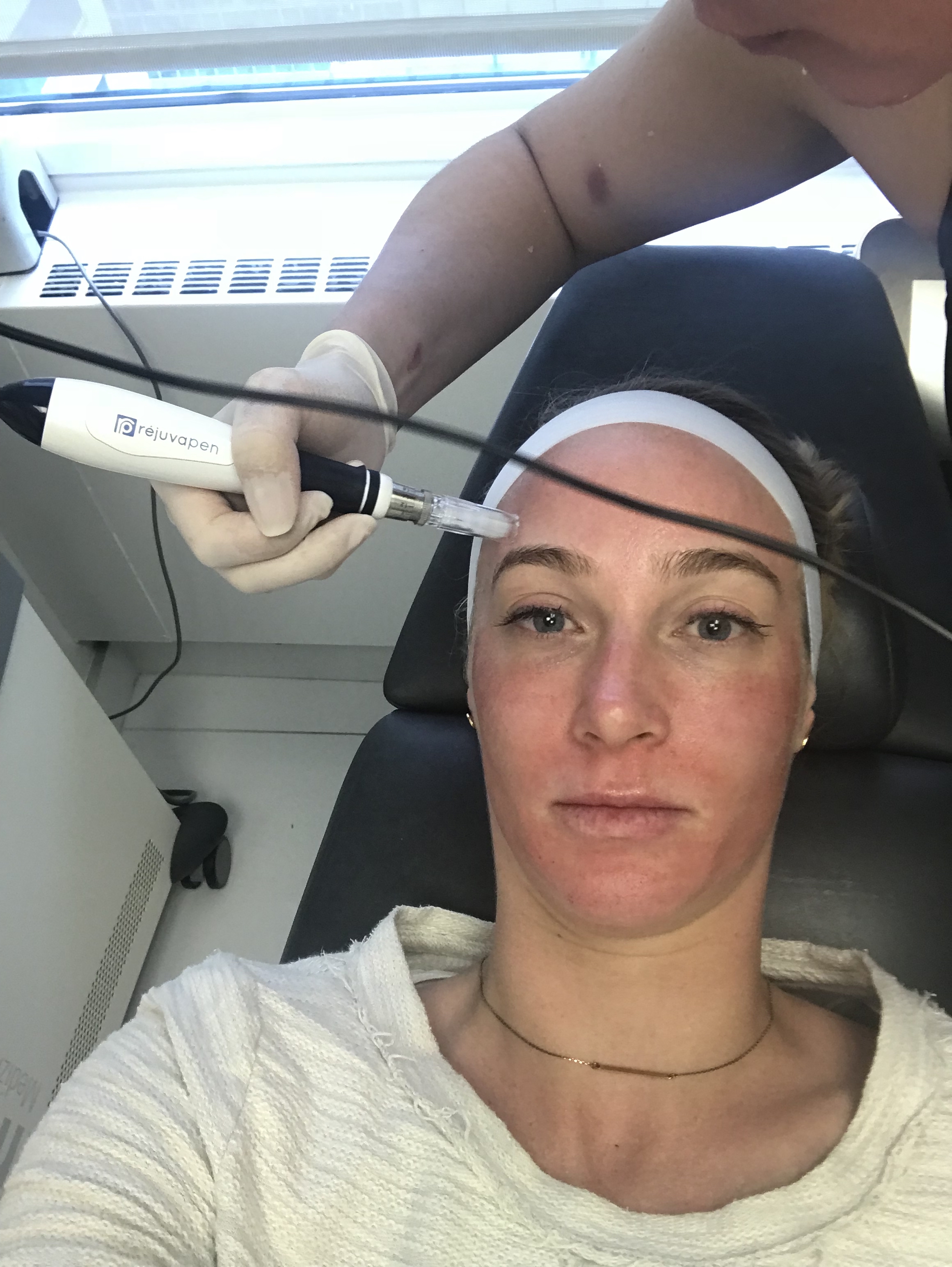 Microneedling NYC | Schweiger Dermatology Group
