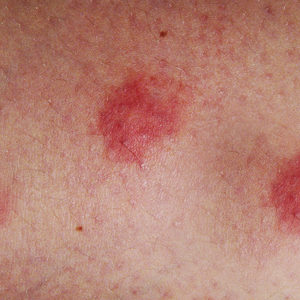 Atopic dermatitis