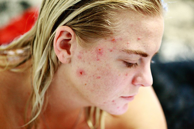 Adult Acne