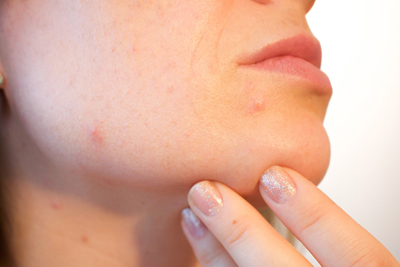 Cystic Acne