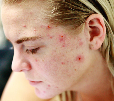 Adult Acne