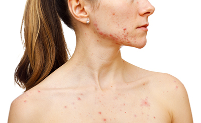 5 Types Of Acne Scars