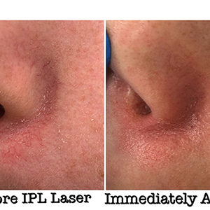 IPL Before and After