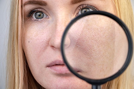rosacea - woman holding magnifying glass across her face