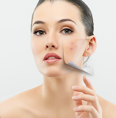 Girl with acne