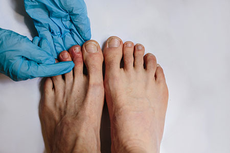 Covid toes
