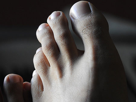 Black toe nails