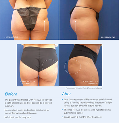 Renuva injectable treatment restoring natural tissue volume