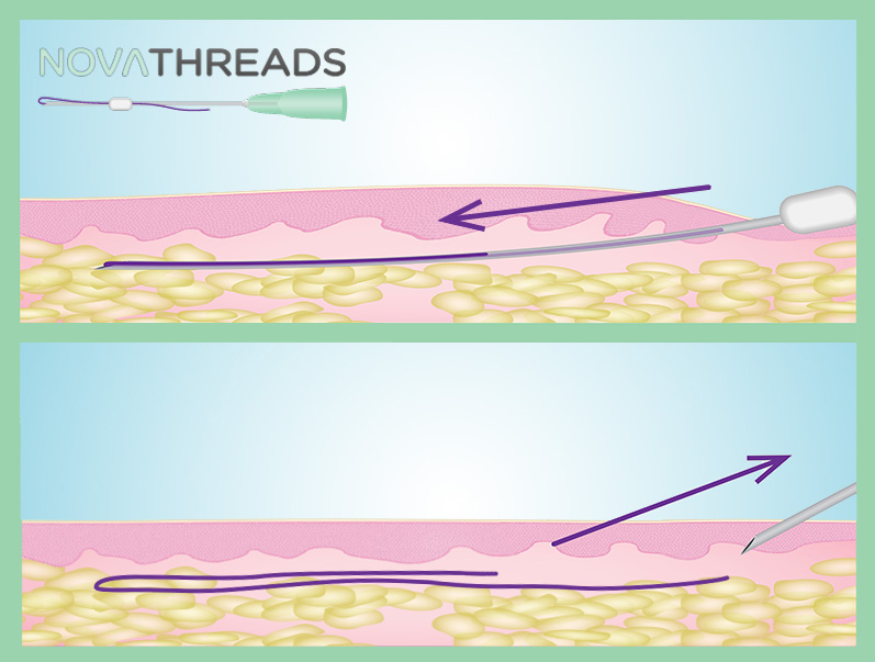 Thread Lifting: The Non-Surgical Face Lift