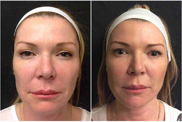 Before and After photos of a female patient who was treated with Silhouette InstaLift Thread Lift treatment