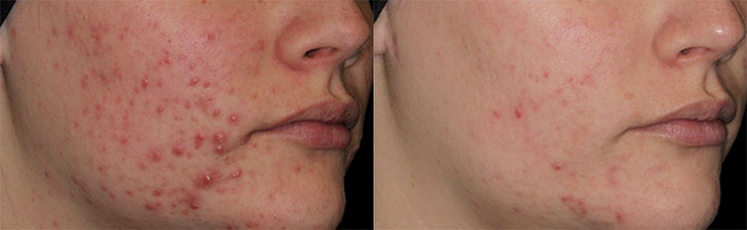 Aviclear Before After patient images
