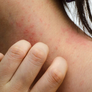 contact dermatitis
