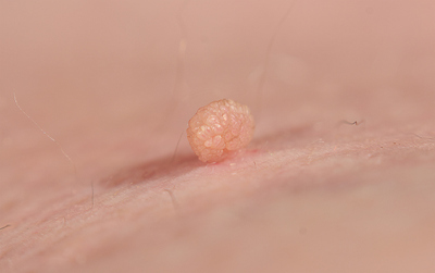 Skin Tag Removal