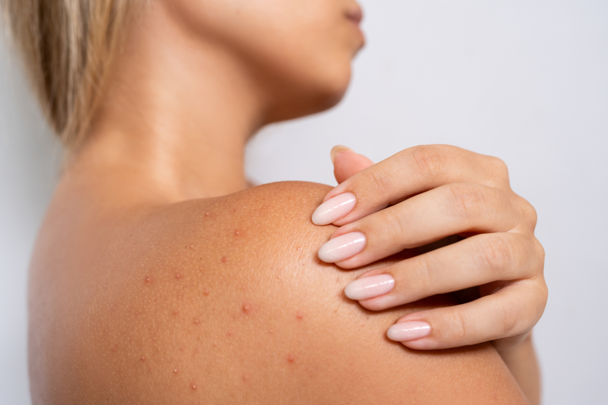 closeup of a woman with back acne