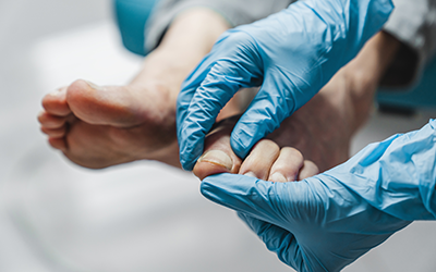 Closeup of toe nail with nail fungus being examined by a doctor.