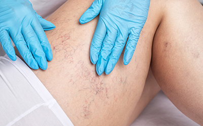 Medical inspection and treatment of varicose veins on the legs.