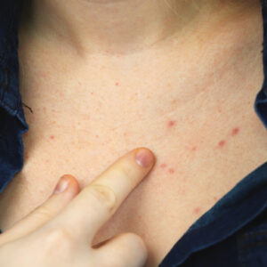 woman pointing at acne on her chest symbolizing chest acne causes