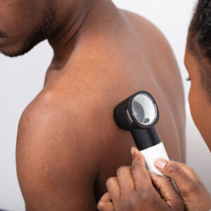 dermatologist looking through a microscope at skin cancer on dark skin