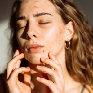 woman illuminated by light closing her eyes while pointing at hormonal acne on her face
