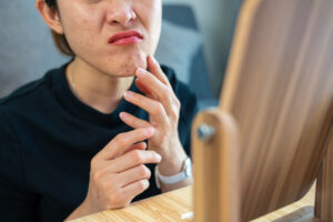 woman looking in the mirror wondering if her rash is acne or allergies