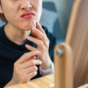 woman looking in the mirror wondering if her rash is acne or allergies