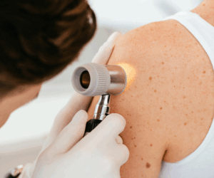 dermatologist looking through a tool at skin during a skin biopsy for skin cancer
