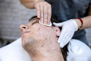 Young man laying down at a dermatologist office while getting treatment for acne scars or dark spots