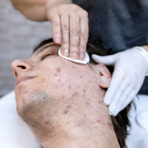 Young man laying down at a dermatologist office while getting treatment for acne scars or dark spots