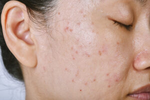 closeup of a woman who had facial seasonal acne