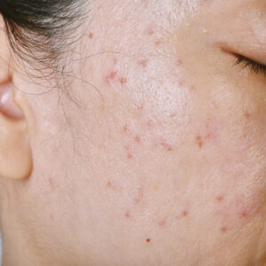 closeup of a woman who had facial seasonal acne