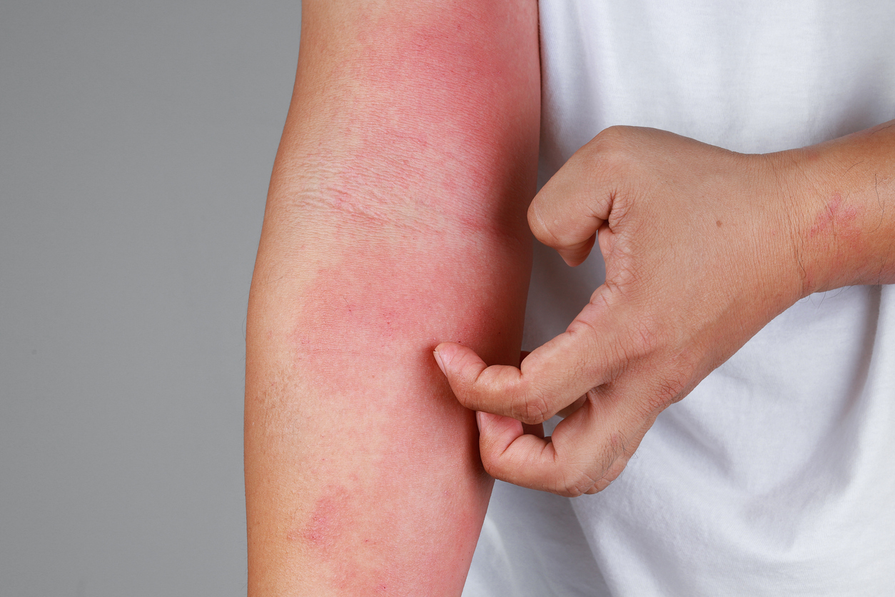 A close up of winter eczema that has flared up on someone's inner elbow