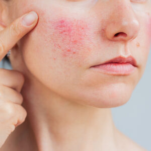closeup shot of a woman pointing at her face, which has either acne or rosacea