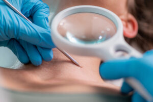 closeup of a dermatologist performing wart removal treatment on a patient
