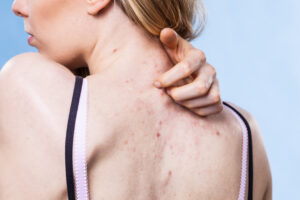 closeup of a woman scratching her back with acne itching