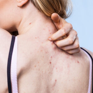 closeup of a woman scratching her back with acne itching