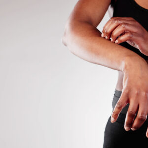 closeup of a woman itching her wrist with either eczema or ringworm