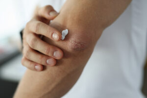 closeup of a woman rubbing cream on her elbow that has dry or dehydrated skin