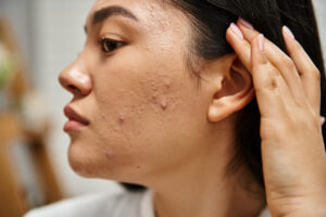 closeup of a girl who has nodular acne on her face