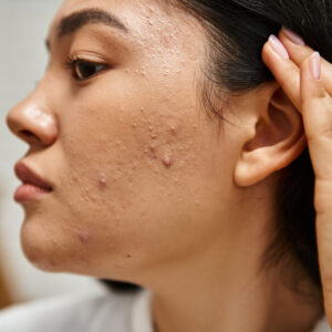 closeup of a girl who has nodular acne on her face