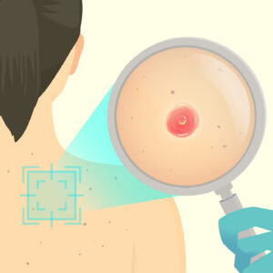 Graphic of a microscope zooming in on basal cell cardinoma