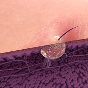 Formation of skin acne or pimple. The sebum in the clogged pore promotes the growth of a certain bacteria Human skin layer. Epidermis, Dermis, Hypodermis and muscle. Hair, Sebaceous gland.