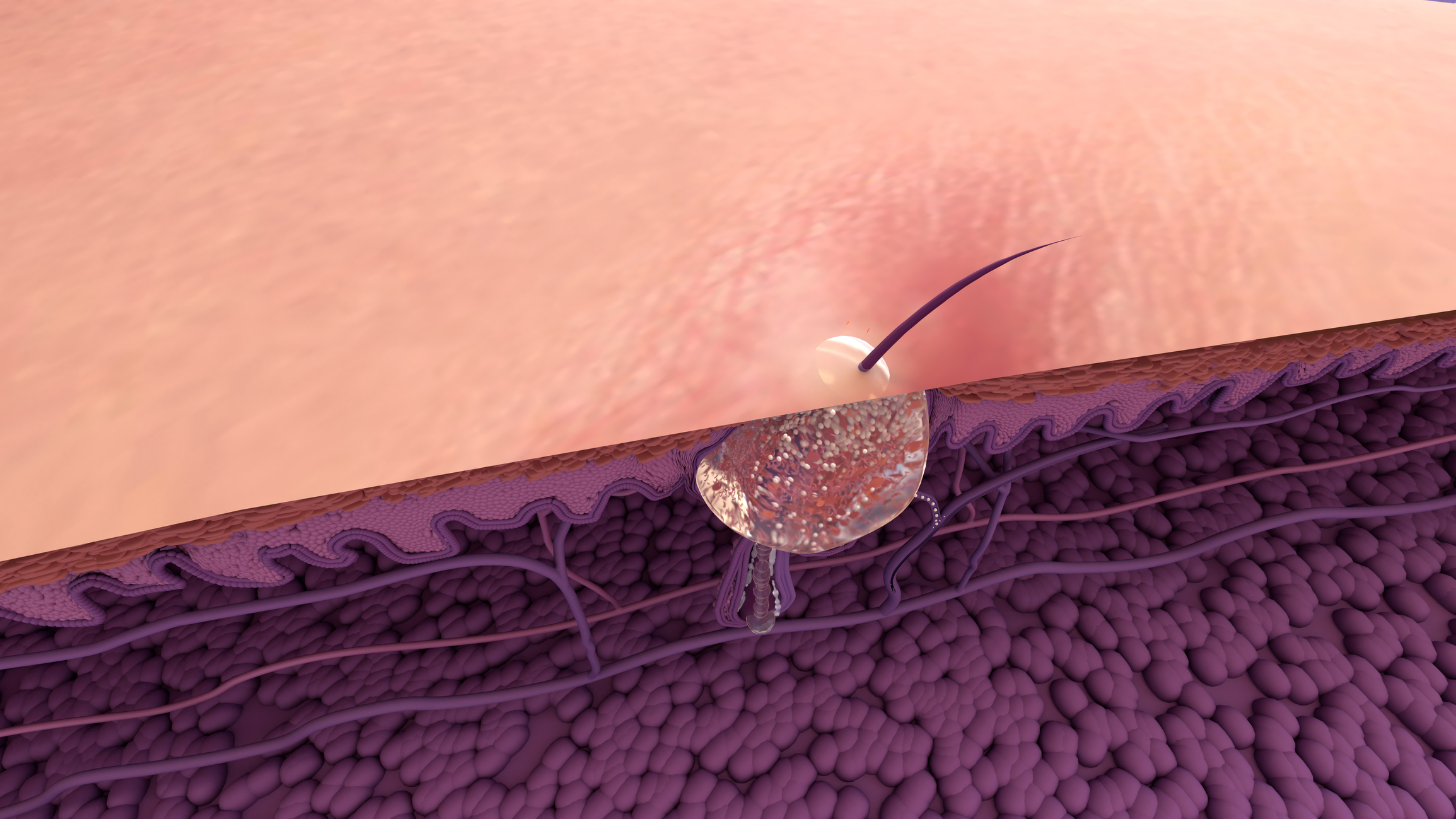 Formation of skin acne or pimple. The sebum in the clogged pore promotes the growth of a certain bacteria Human skin layer. Epidermis, Dermis, Hypodermis and muscle. Hair, Sebaceous gland.